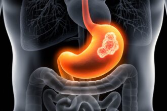 stomach cancer