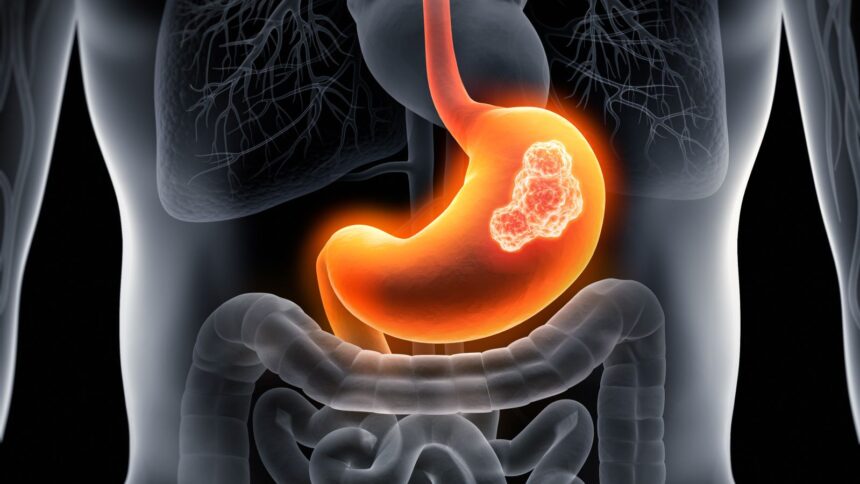 stomach cancer