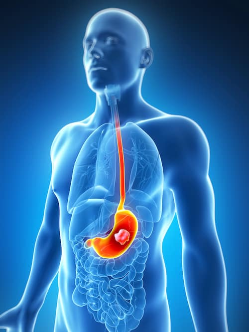 stomach cancer
