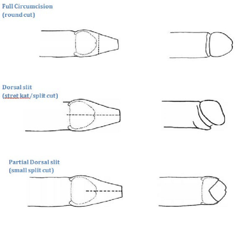 flower cut circumcision