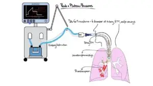 peak inspiratory pressure