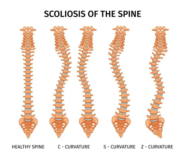 depomethod scoliosis