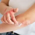 natural treatments for eczema